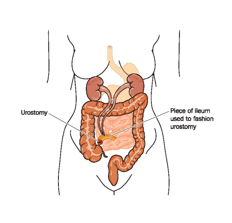 What is an Ostomy? l United Ostomy Associations of America