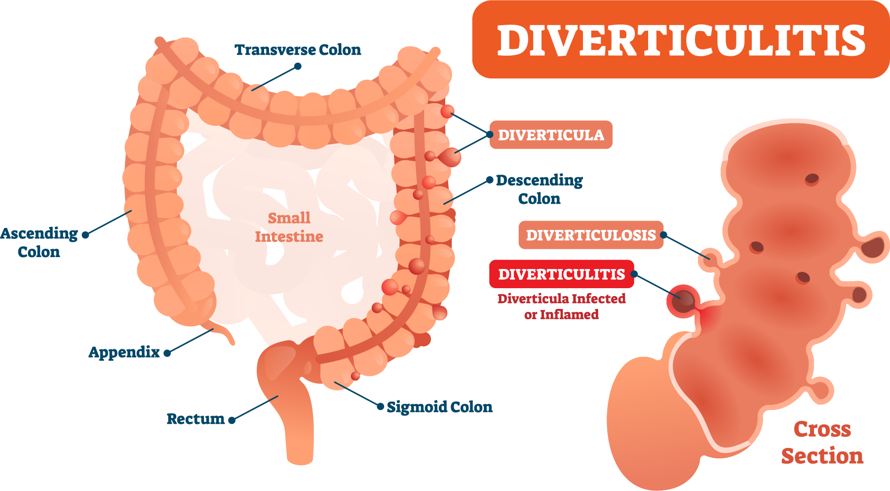 Alimentos prohibidos diverticulitis