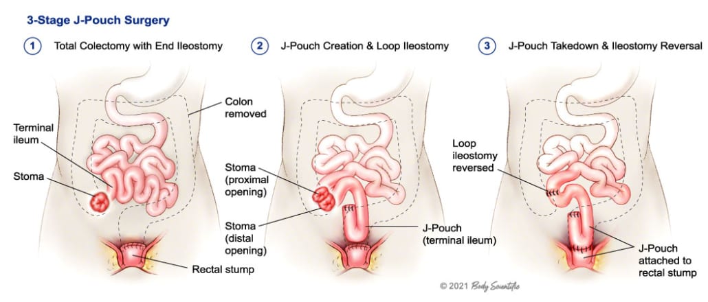 Stages of J-Pouch Surgery