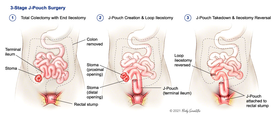 life expectancy with stoma bag