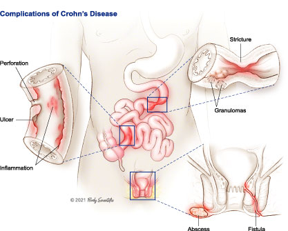 Complications of Crohn