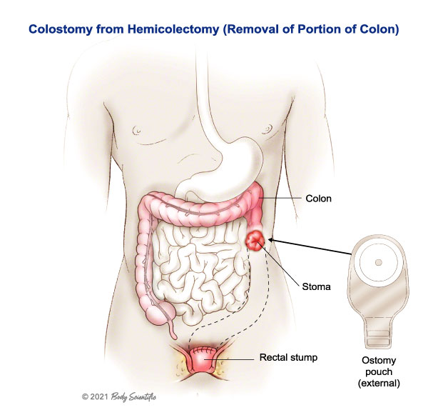 Colostomy from Hemicolectomy