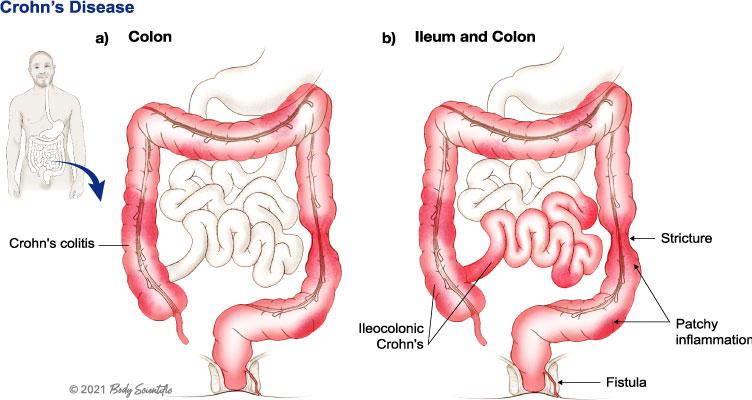 What is Crohn's Disease