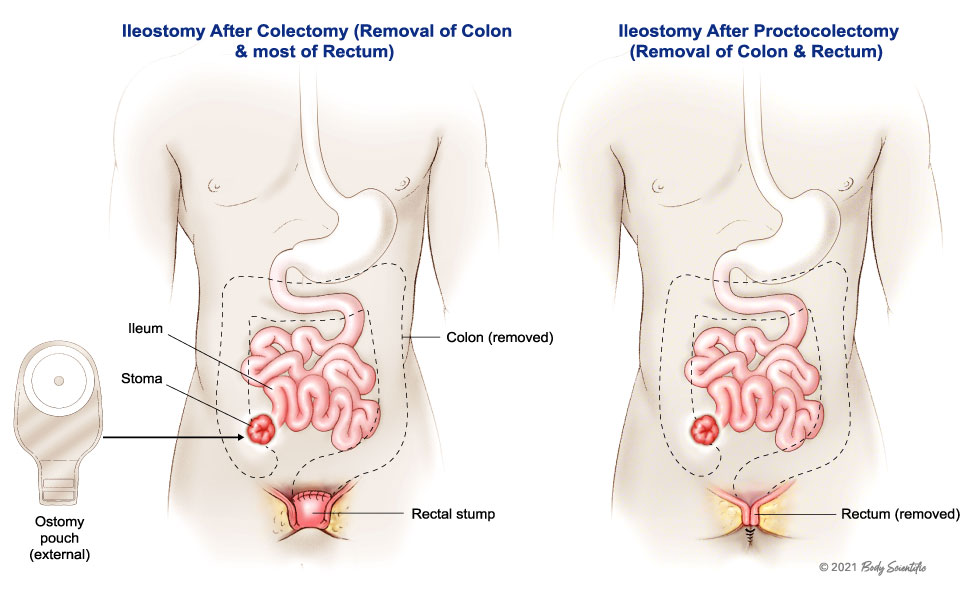 Ileostomy After Colectomy and Proctocolectomy