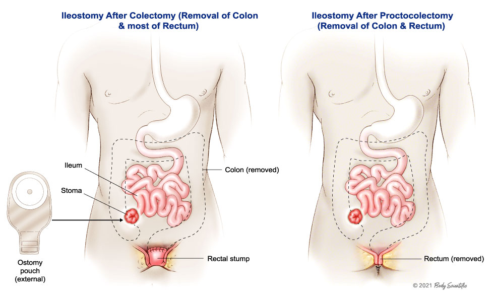 Ileostomy Types