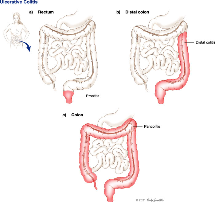 What is ulcerative colitis