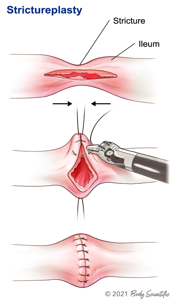 Strictureplasty illustration