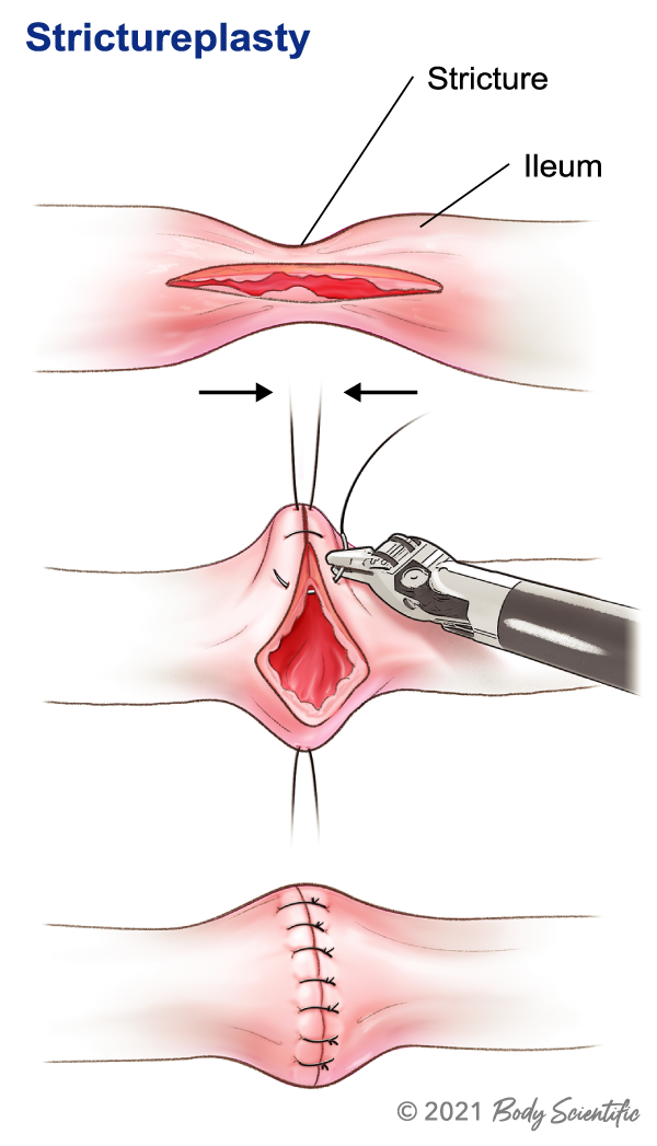 Strictureplasty-V1 Strictureplasty illustration