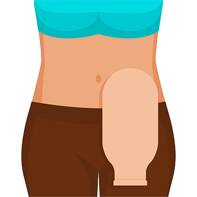 https://www.ostomy.org/wp-content/uploads/2021/12/yong-woman-ostomy-bag.png