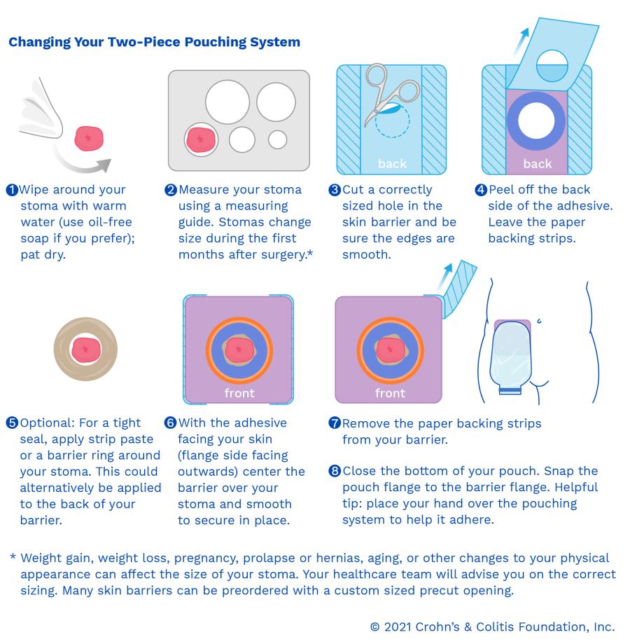 Types of Pouching Systems l United Ostomy Association Of America