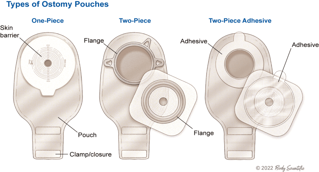 Types of ostomy bags or pouches ileostomy