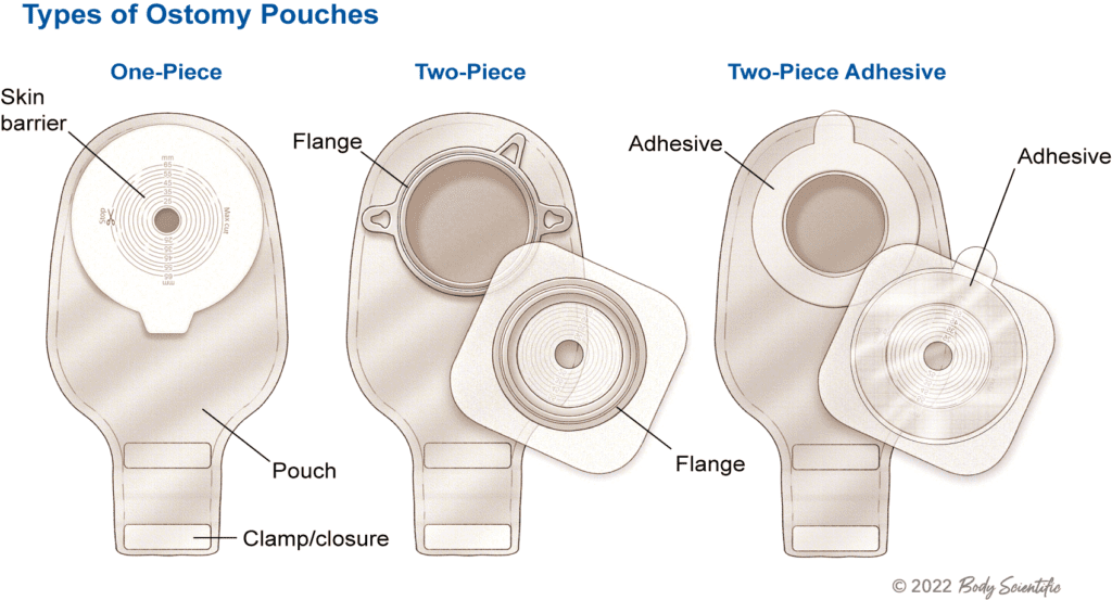 A properly fitting stoma bag with stoma adhesives is essential for