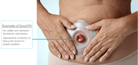 British Journal of Nursing - Impact of stoma leakage in everyday life: data  from the Ostomy Life Study 2019
