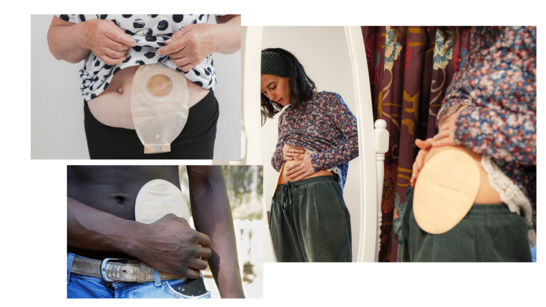 Tips for Choosing the Right Ostomy Supplies - United Ostomy ...