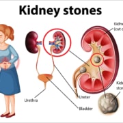 Informative illustration of kidney stones