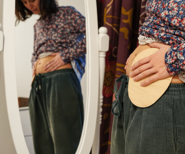 Woman looking at her new ostomy