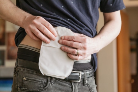 The Reality of Life with an Ostomy – Coloplast-UOAA blog